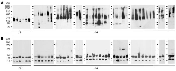 Transthyretin aggregates in the synovial fluid of juvenile idiopathic ar...