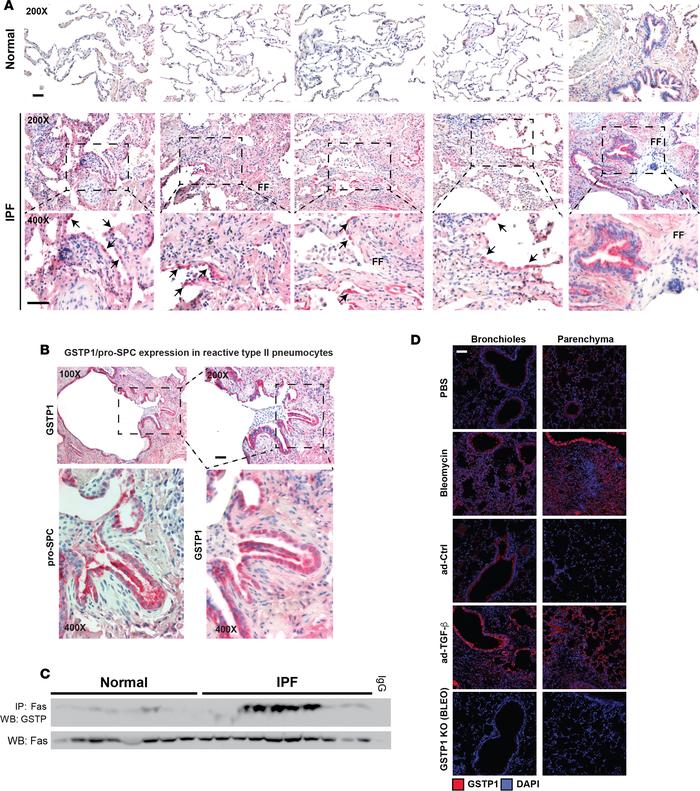 GSTP immunoreactivity and FAS-GSTP interaction are increased in the lung...