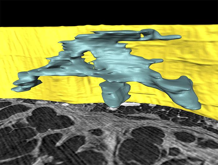 Fibroblast foci are locally complex structures.
A computer-generated 3D ...