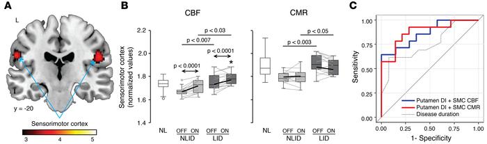 Increased resting activity in the sensorimotor cortex in unmedicated lev...