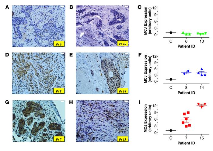 Variable levels of MCJ expression in primary breast cancer biopsies.
(A)...