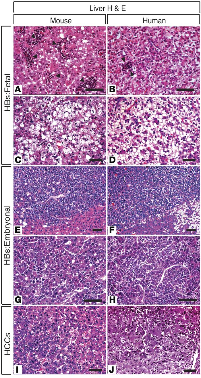 Comparative histopathology of mouse and human HBs and HCCs.
Photomicrogr...