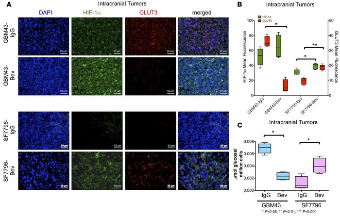 Increased GLUT3 expression in bevacizumab-resistant patient-derived xeno...