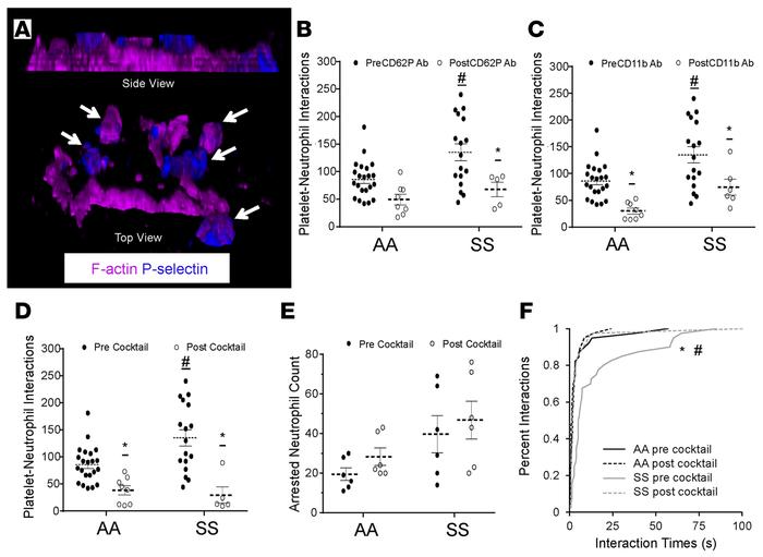 Neutrophil-platelet aggregation in sickle cell disease (SCD) human blood...