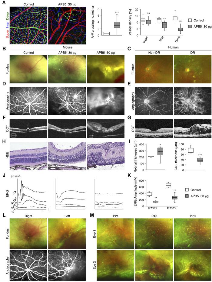 Adult mouse model reproducing characteristics of diabetic retinopathy (D...