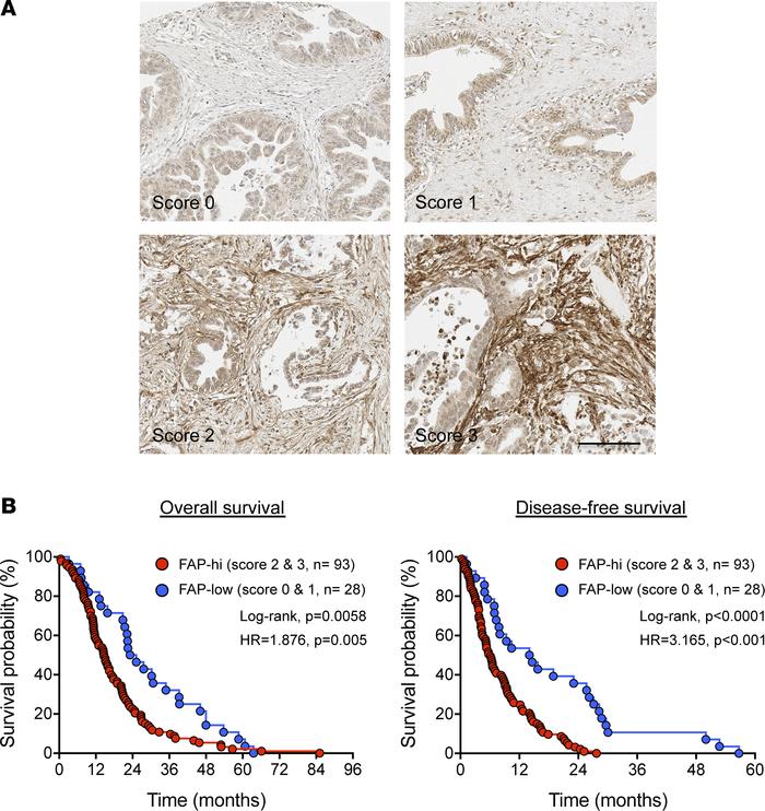 FAP expression levels correlate with poor clinical outcome in human PDA....