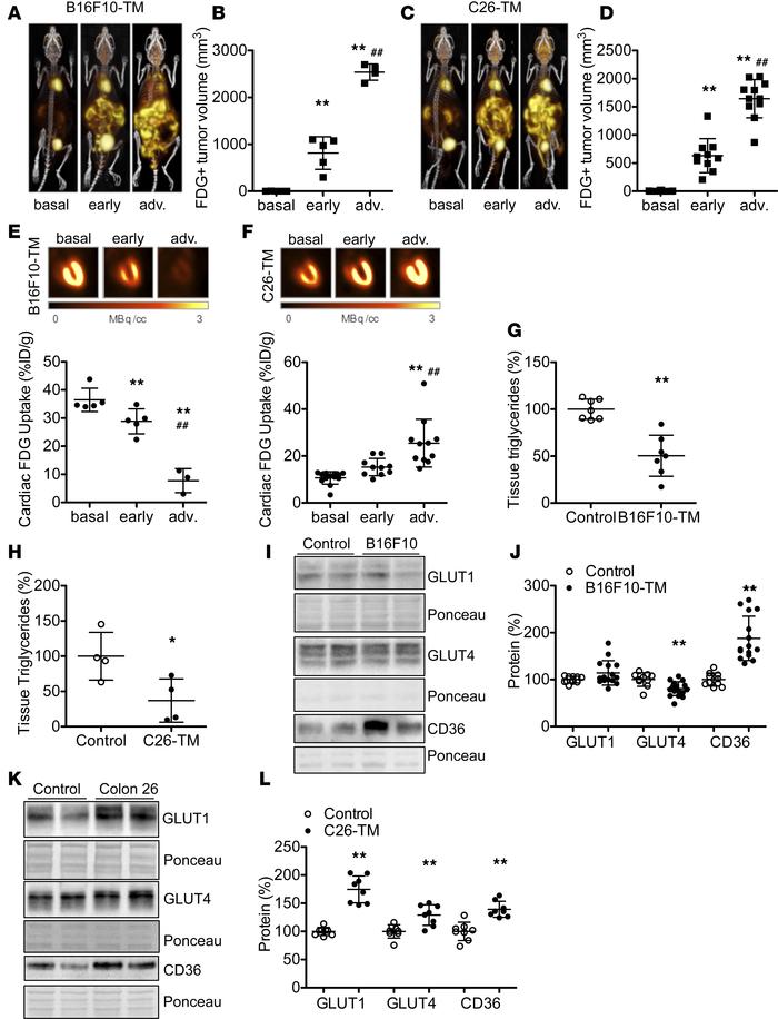 Effect of progressive tumor growth on myocardial glucose uptake and meta...