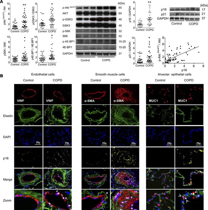 Analysis of lung samples from 30 patients with COPD and 30 controls.
(A)...