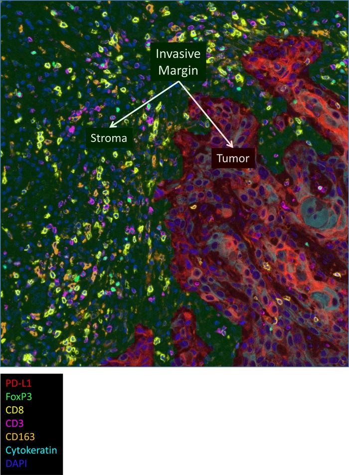 Representative image of immune cell infiltrate in an OSCC tumor.
Tissue ...