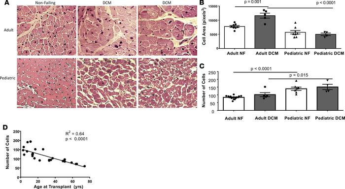 Pediatric and adult DCM cell area and number from 4 dilated cardiomyopat...