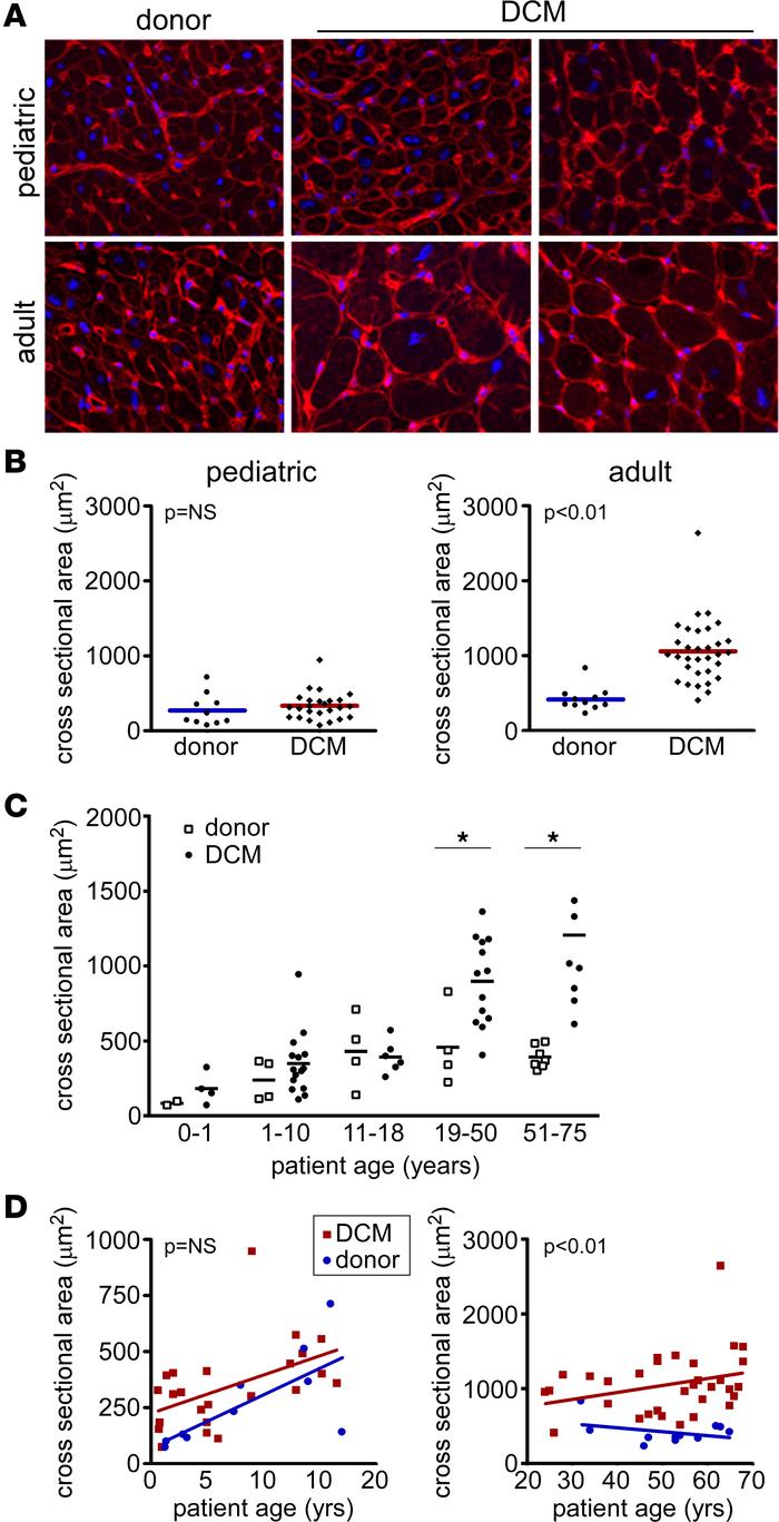 Absence of cardiomyocyte hypertrophy in pediatric DCM.
(A) Wheat germ ag...