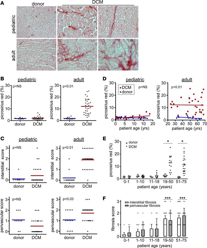 Absence of myocardial fibrosis in pediatric DCM.
(A) Picrosirius red sta...