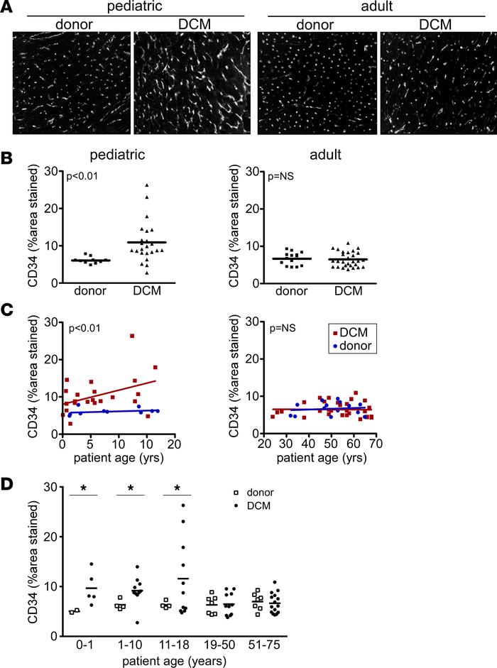 Microvascular alterations in pediatric and adult DCM.
(A) CD34 immunosta...