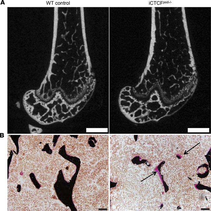 Bone histomorphometry reveals bone loss, osteomalacia, and increased res...