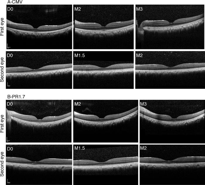 Optical coherence tomography (OCT) follow-up of AAV2-7m8-CMV-GFP– and PR...