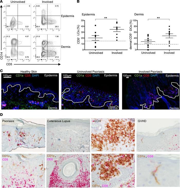 CD5+ LCs and dermal DCs are increased in psoriatic lesions compared with...