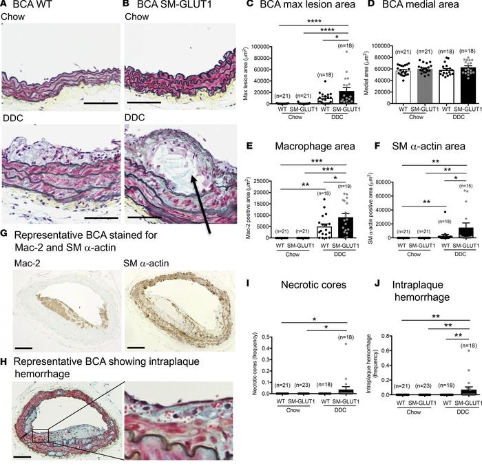 Smooth muscle–targeted GLUT1 overexpression increases BCA lesion size an...