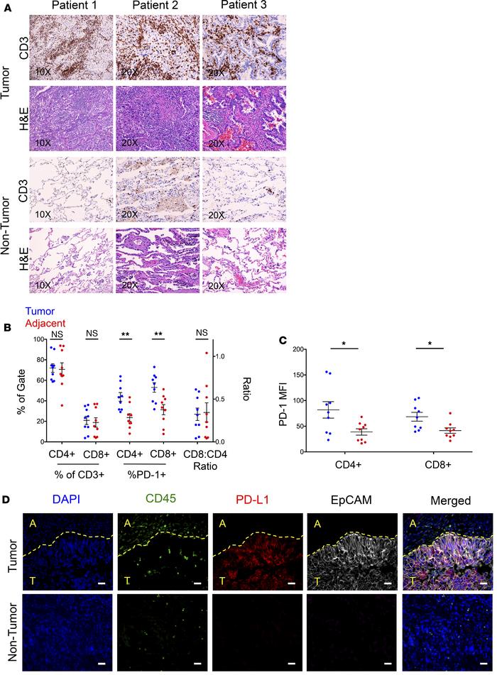 Prevalent PD-1/PD-L1 axis in early-stage human lung cancer patients.
(A)...