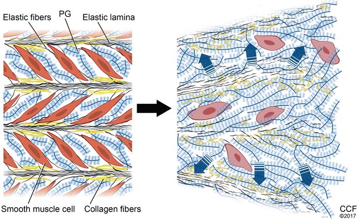 Model depicting the impact of large aggregating proteoglycan accumulatio...