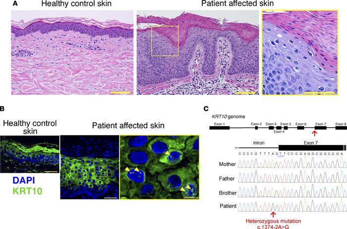 Histological and genetic features of the patient.
(A) Compared with heal...