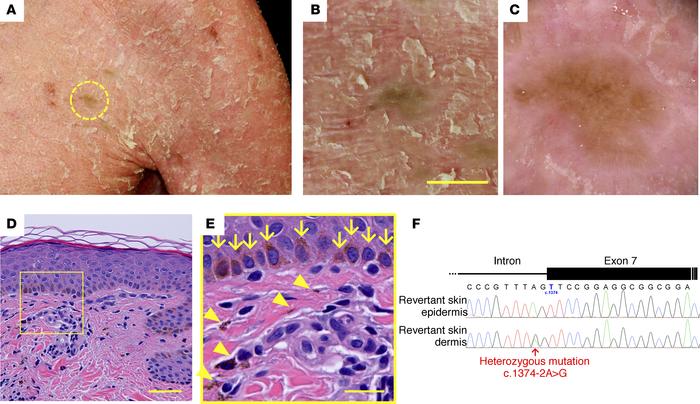 Identification of revertant spots.
(A–F) Gross (A and B), dermoscopic (C...
