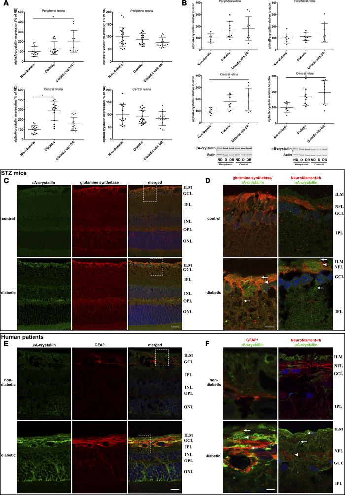 Cell-specific upregulation of α-crystallins in diabetic patients with an...