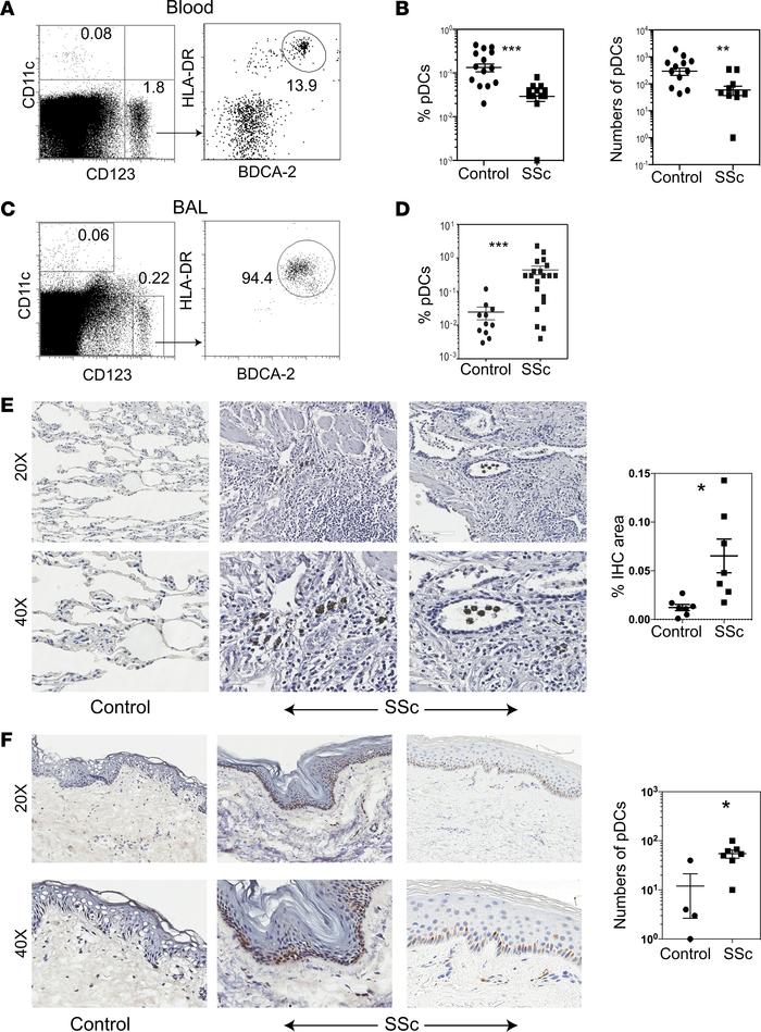 Detection of pDCs in the peripheral blood, BAL, and lung and skin tissue...